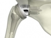 reverse-total-shoulder-replacement